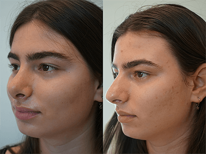 The Different Types of Rhinoplasty Procedures