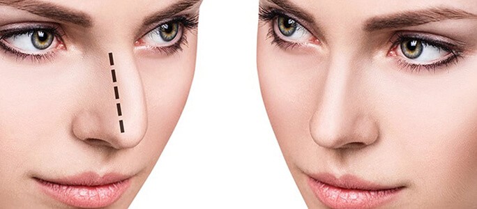 rhinoplasty description