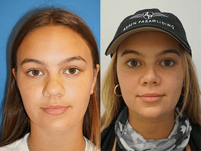 rhinoplasty drjsalomon