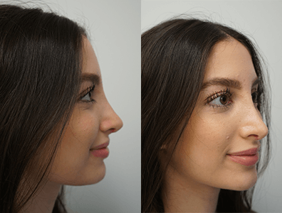 rhinoplasty types drjsalomon